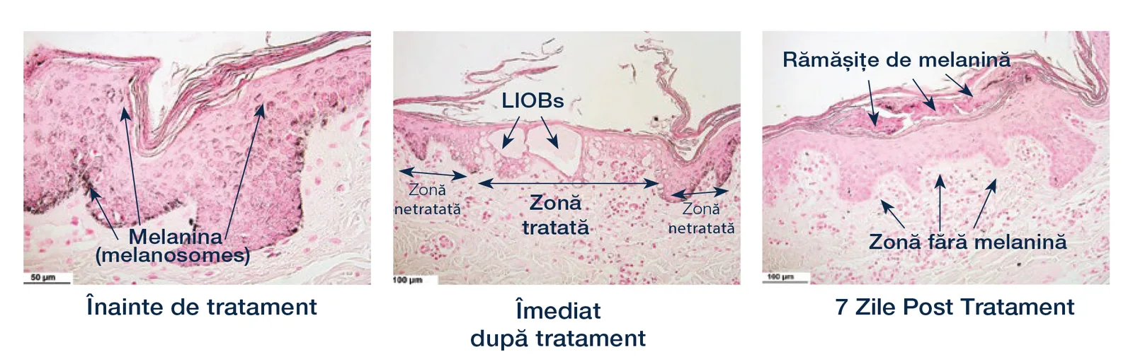 Tratamentul PicoFractional — laser fotoacustic fracționat