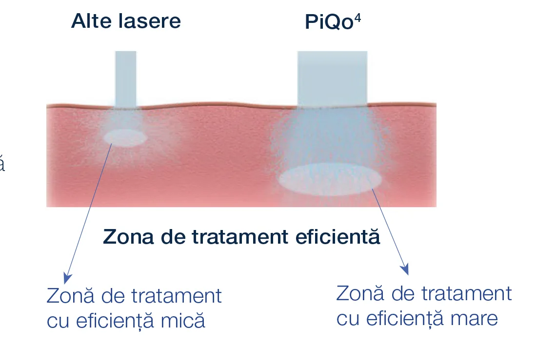 Zona de tratament eficientă obținută cu un spot de dimensiuni mari