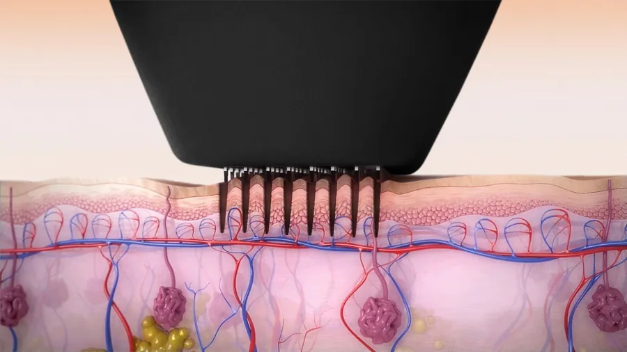 NanoFractional RF skin slice